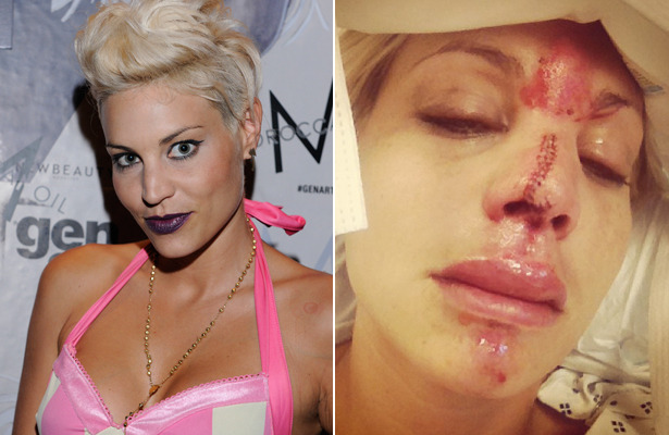 'America's Next Top Model's' Face Injured in 'Freak Accident'